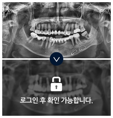 임플란트-전후사진1