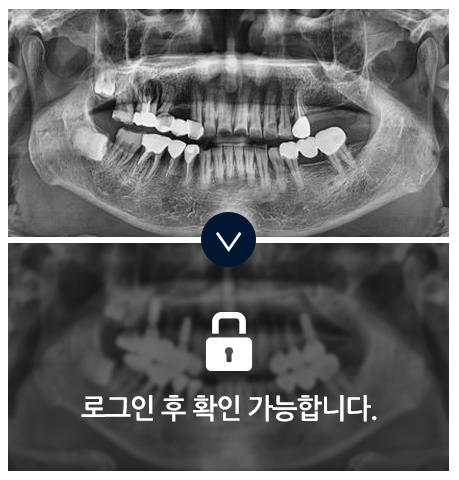 임플란트-전후사진2