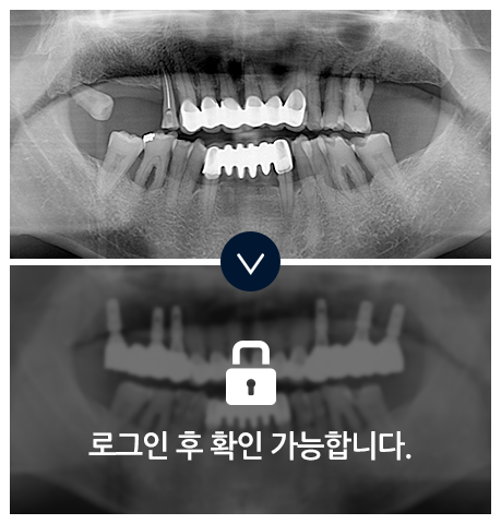 임플란트-전후사진3