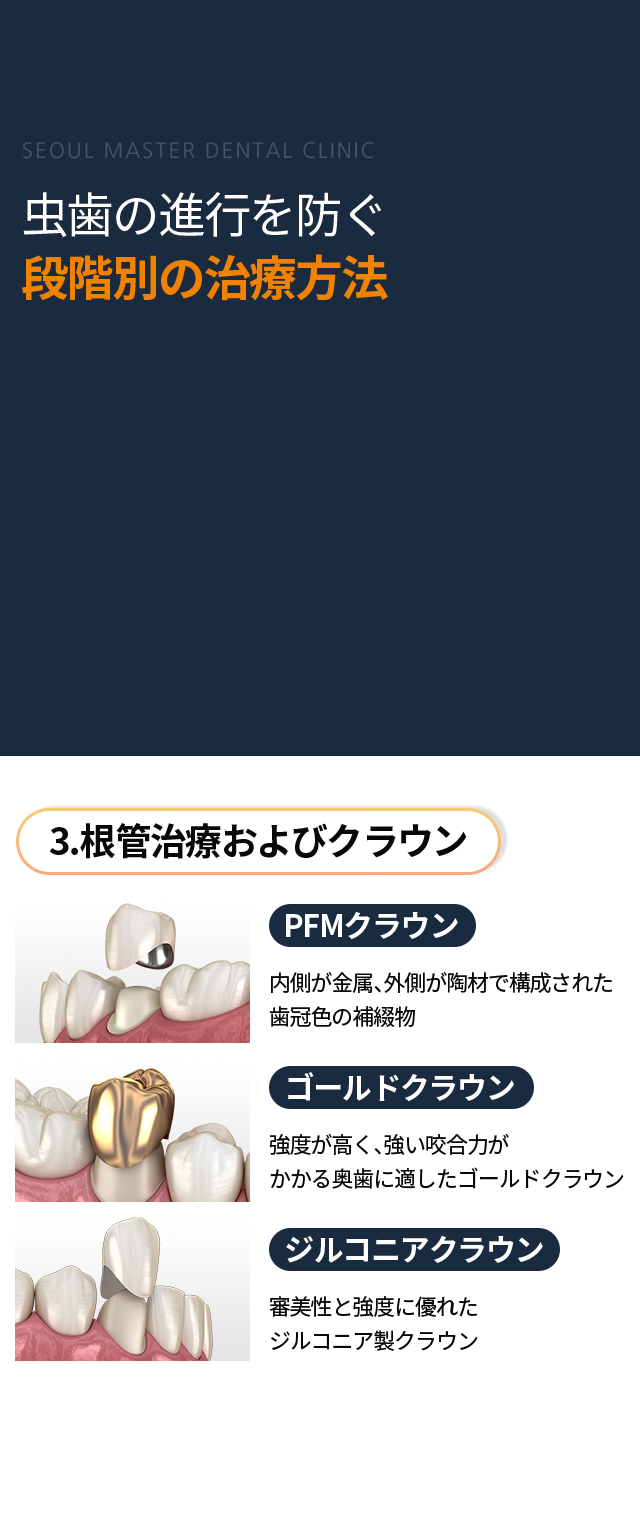 3단계-신경치료-및-크라운-종류1-PFM-크라운-내부는-메탈-겉은-도자기로-구성된-치아색상-보철물-종류2-골드-크라운-강도가-강해-씹는-힘이-강한-어금니-부위에-적합한-골드-크라운-종류3-지르고니아-크라운-심미적으로-우수하고-강도가-높은-지르코니아-크라운
