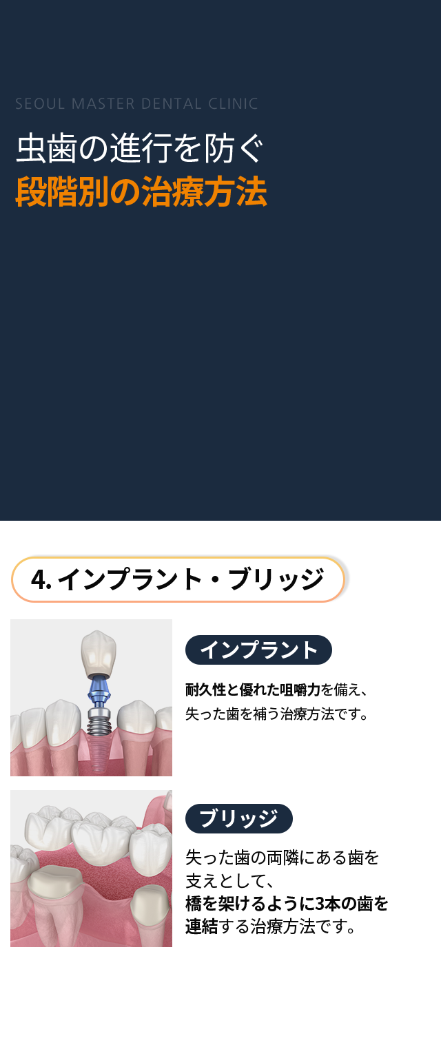 4단계-임플란트/브릿지-임플란트-오랜-수명과-우수한-저작력으로-상실된-치아를-대체하는-치료-방법-브릿지-상실-부위-앞뒤-치아를-이어서-다리처럼-세-개의-치아를-연결하는-방법
