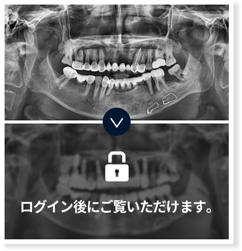 임플란트-전후사진1