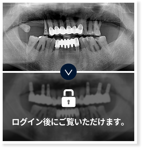 임플란트-전후사진3