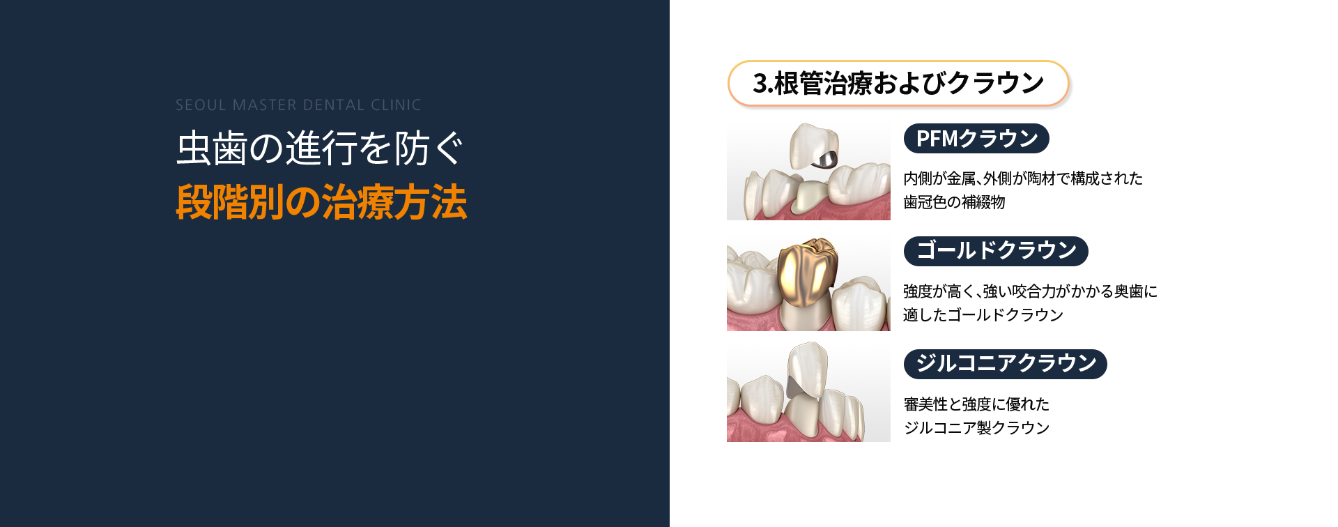 3단계-신경치료-및-크라운-종류1-PFM-크라운-내부는-메탈-겉은-도자기로-구성된-치아색상-보철물-종류2-골드-크라운-강도가-강해-씹는-힘이-강한-어금니-부위에-적합한-골드-크라운-종류3-지르고니아-크라운-심미적으로-우수하고-강도가-높은-지르코니아-크라운