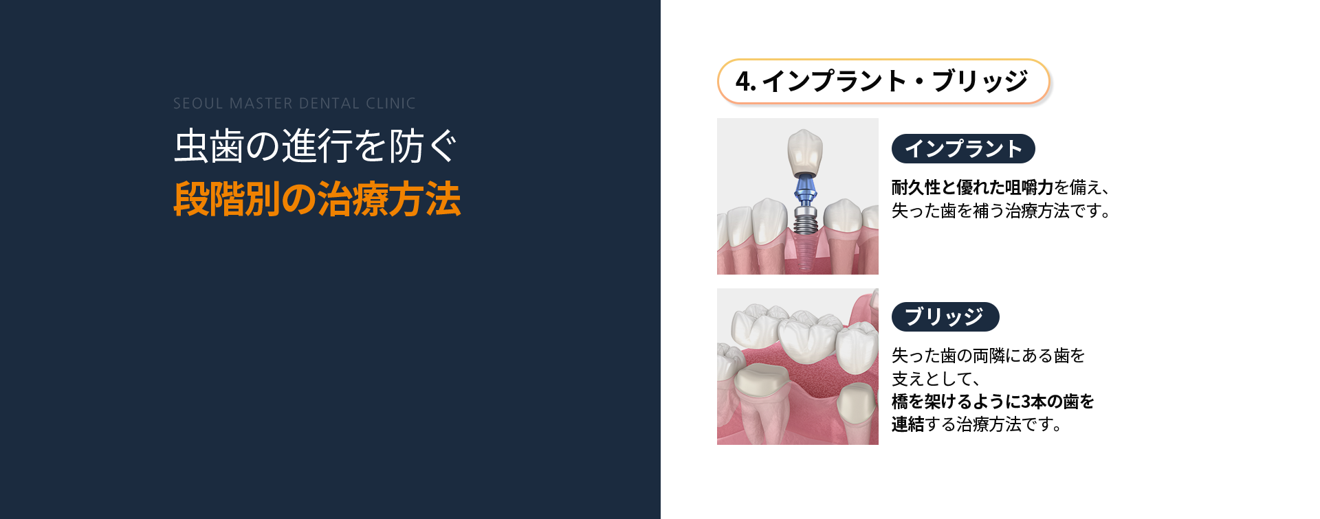 4단계-임플란트/브릿지-임플란트-오랜-수명과-우수한-저작력으로-상실된-치아를-대체하는-치료-방법-브릿지-상실-부위-앞뒤-치아를-이어서-다리처럼-세-개의-치아를-연결하는-방법