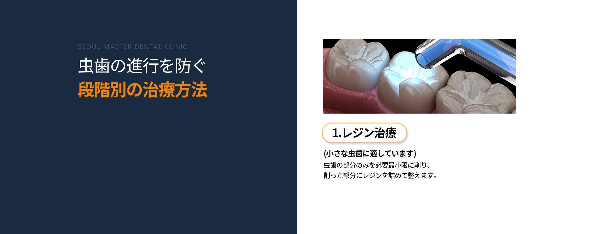 1단계-레진치료-충치가-작은-부위에-적합-충치가-생긴-곳만-살짝-제거한-후-긁어낸-부위를-레진으로-채워-메꿔줍니다